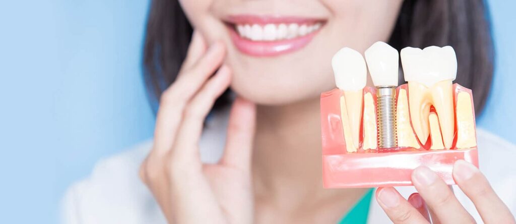 All about Dental Implants