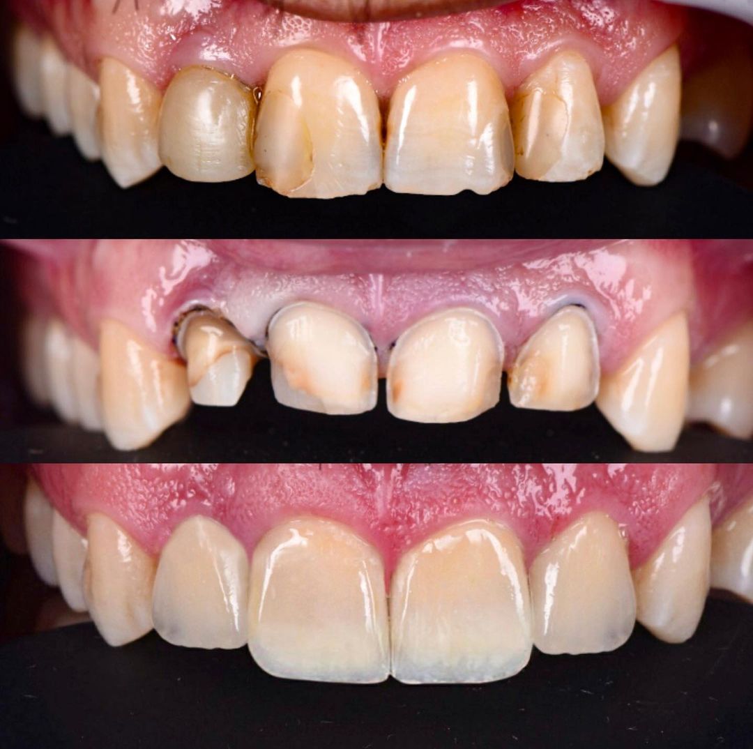 before-after-cosmetic-dentistry-course
