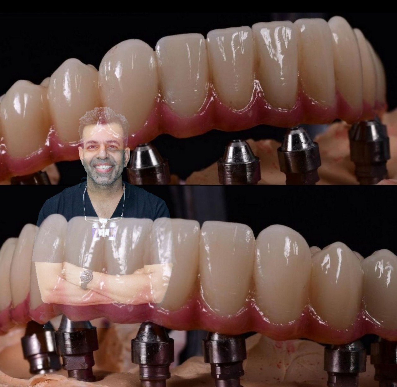 dental-implants-india