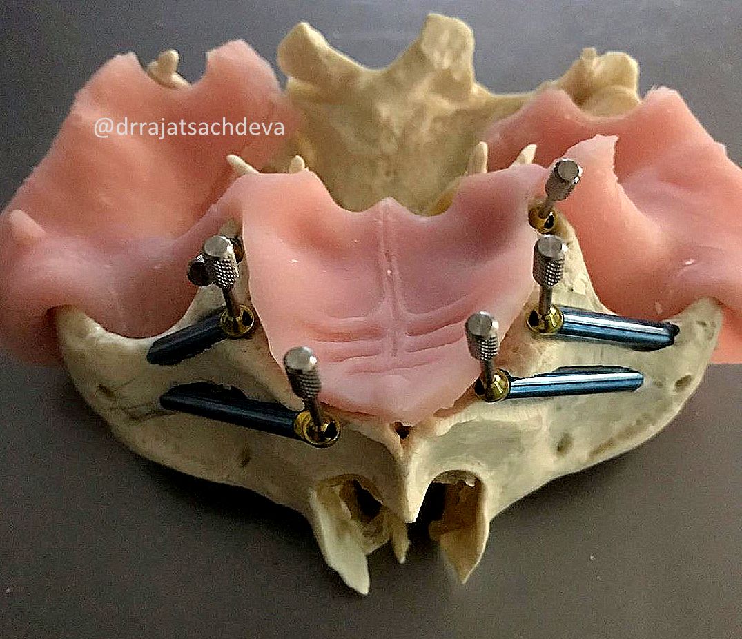 zygomatic course delhi details overview