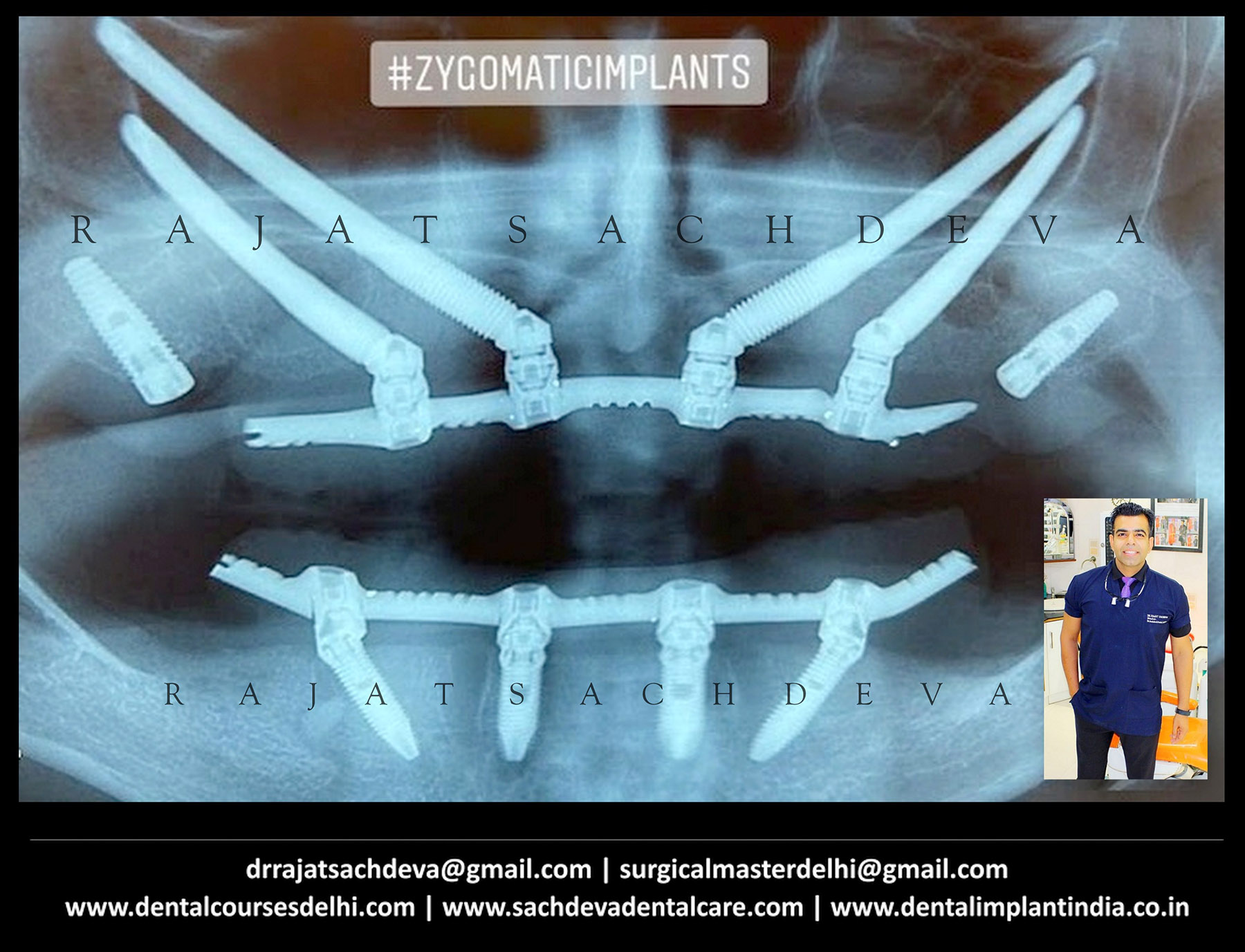 zygomatic course details