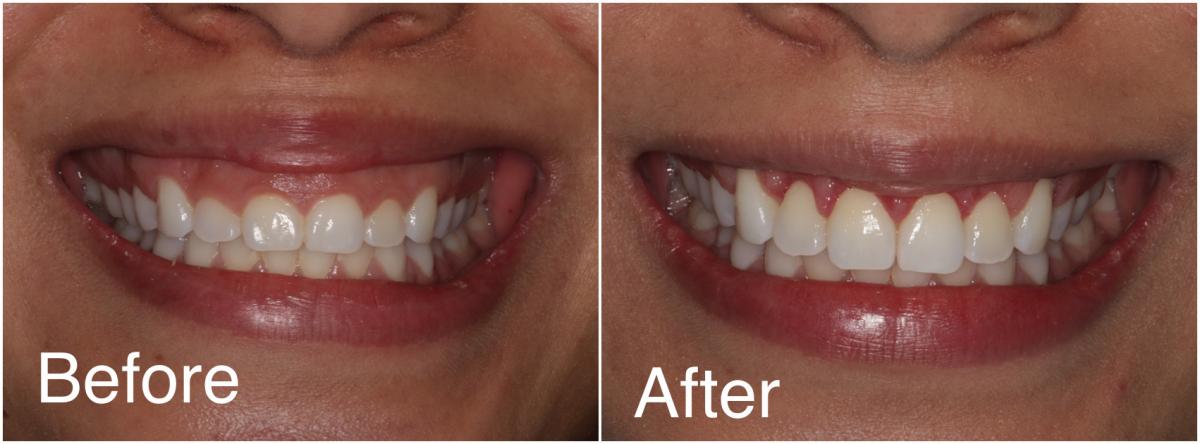 gummy-smile-correction-by-dr-rajat-sachdeva-dental-courses-delhi