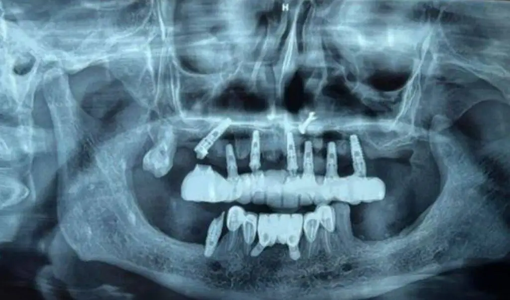 failing implants what to do and when
