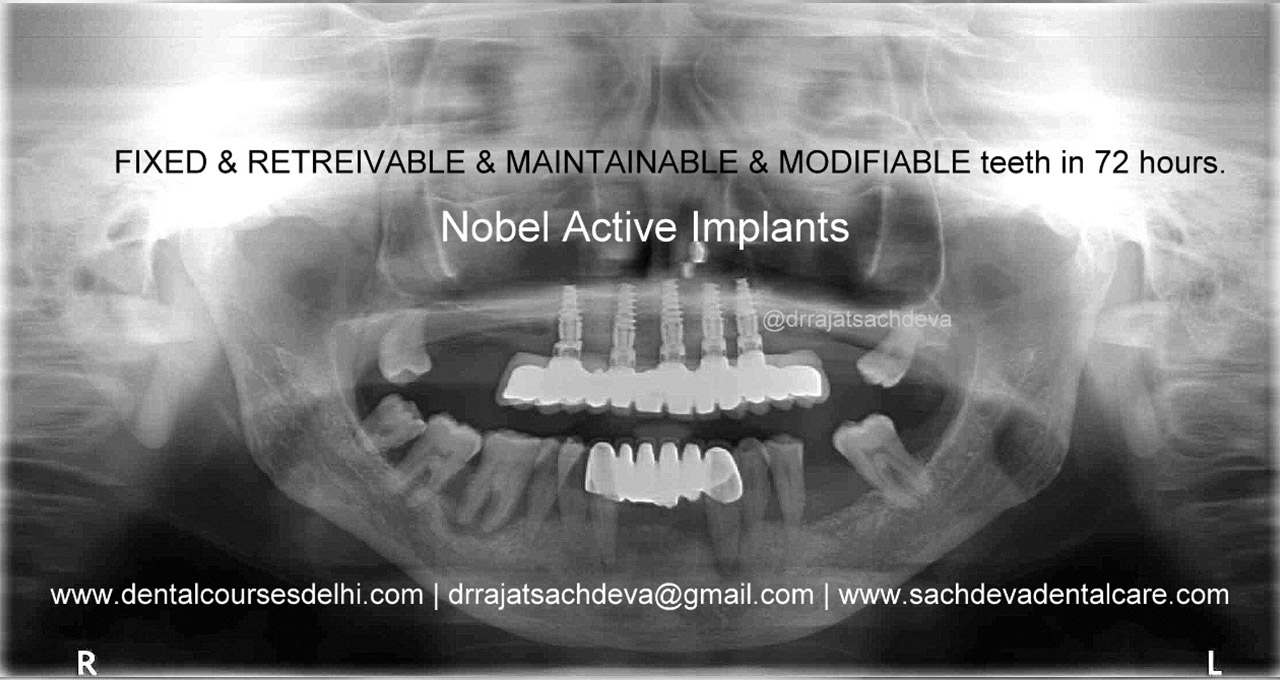 noble active implants in india