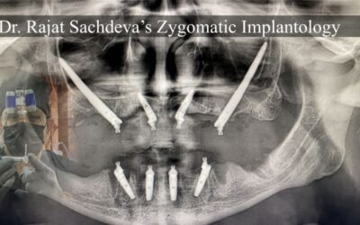 Cost of Full Mouth Dental Implants in India