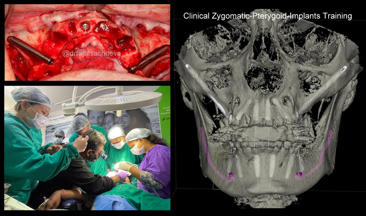 Pterygoid implant course
