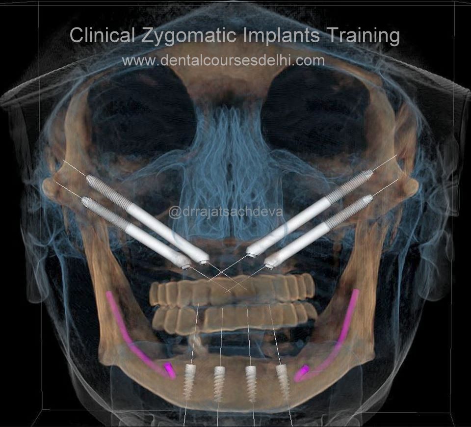 complete zygomatic implant courses in india