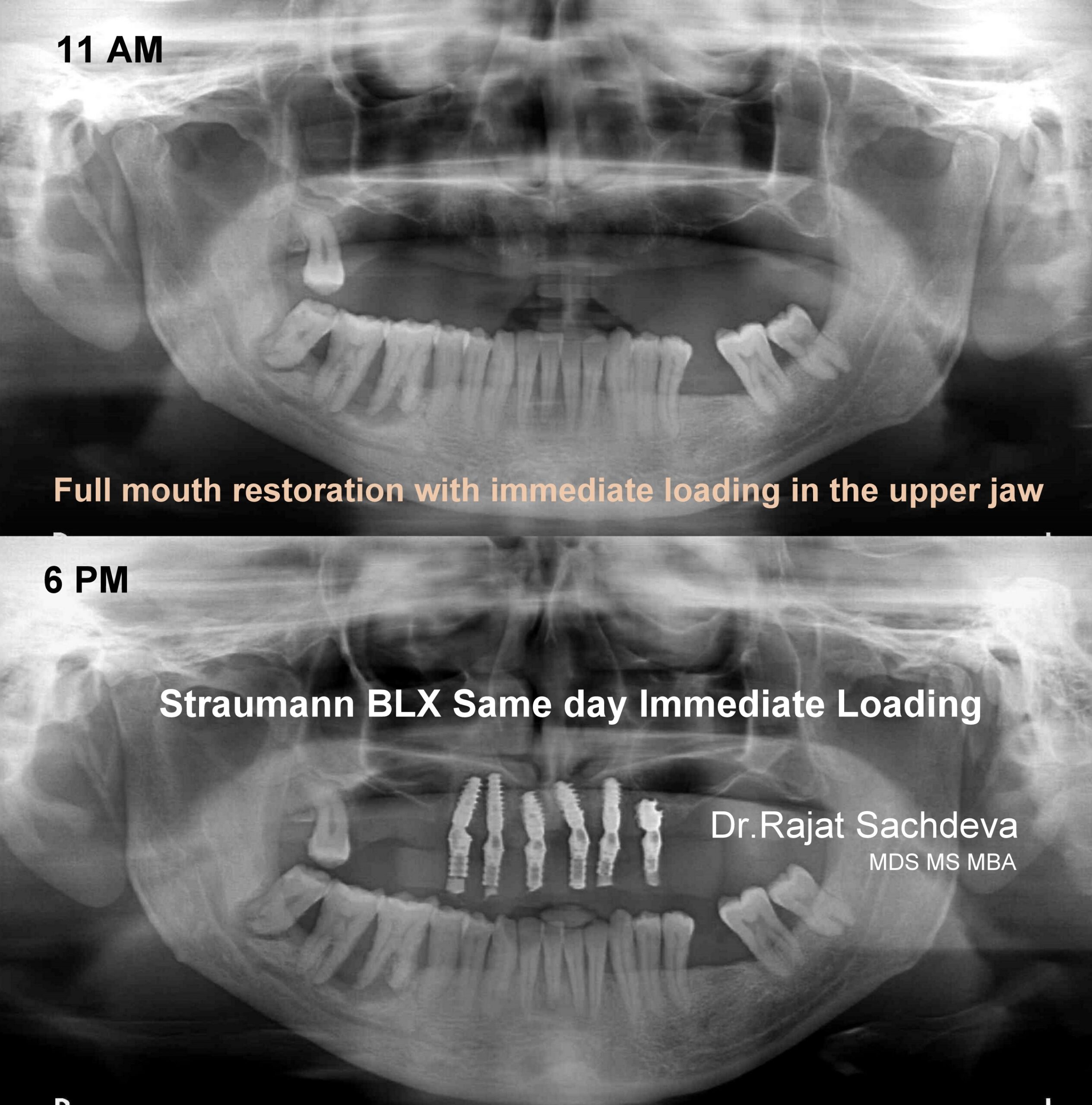 immediate implants placement by dr rajat sachdeva