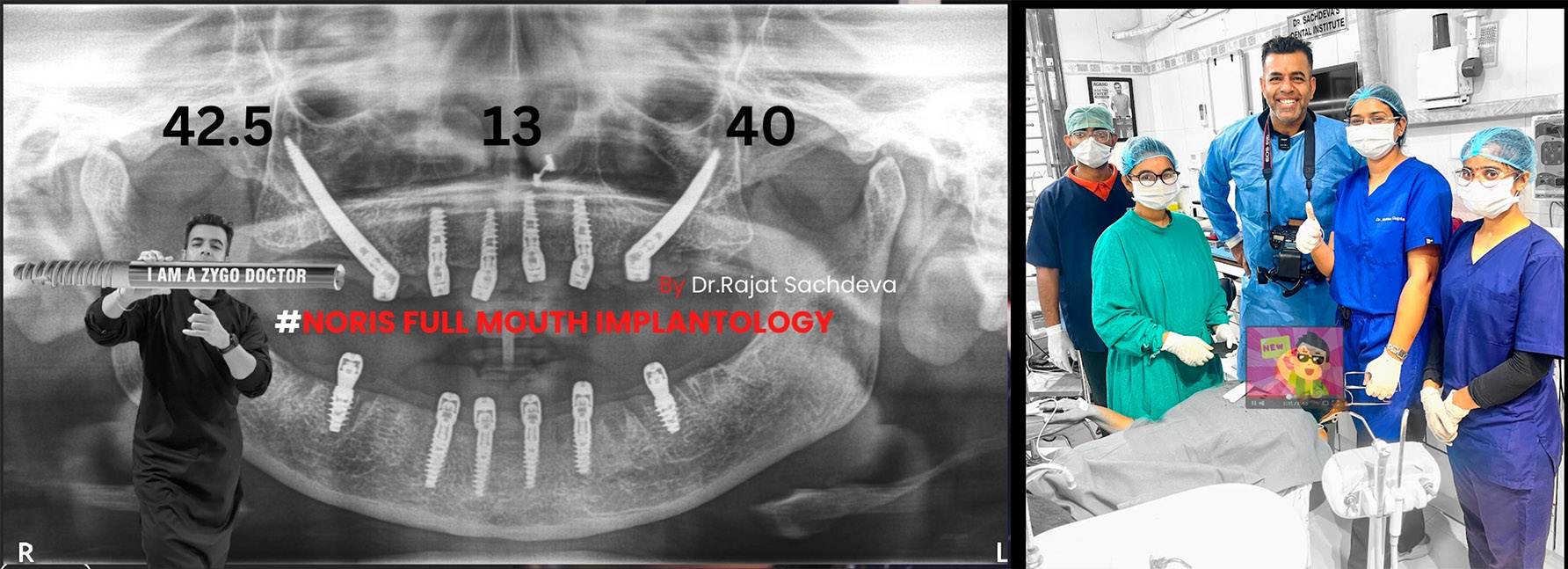 Clinical Zygomatic Implant Course