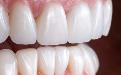 Enhance Your Smile Effortlessly with Composite Bonding