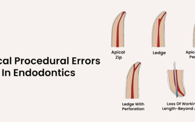 Common Clinical Procedural Errors in Endodontics