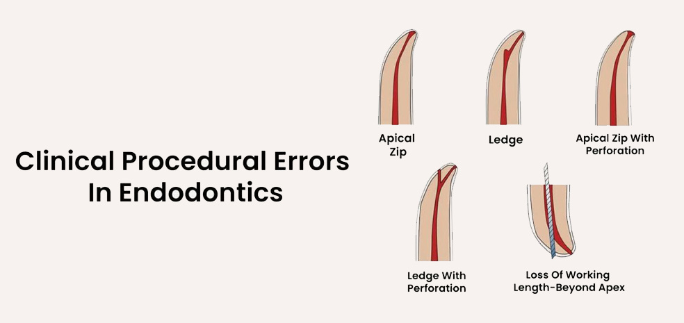 Common Clinical Procedural Errors in Endodontics