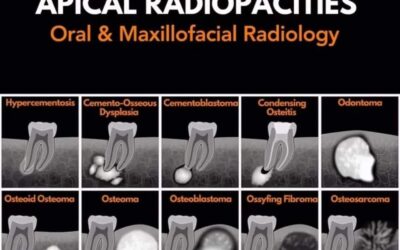Understanding Apical Radiopacities