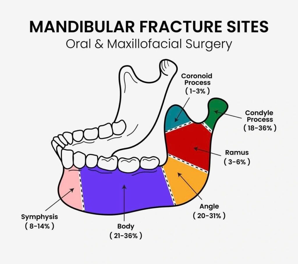 Understanding Mandibular Fracture Sites