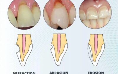 Understanding Non-Carious Lesions
