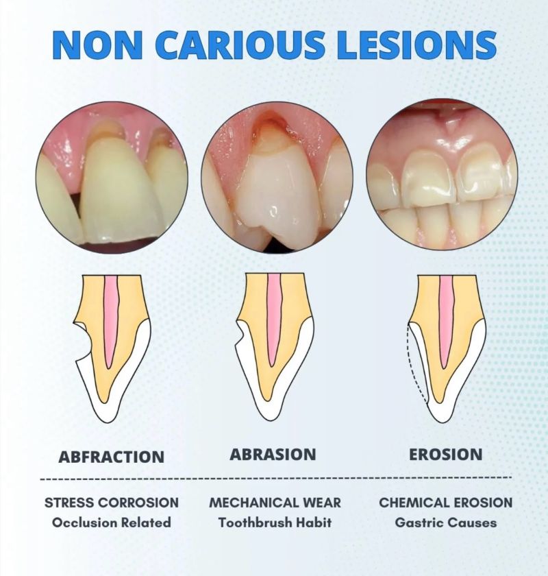 Understanding Non-Carious Lesions
