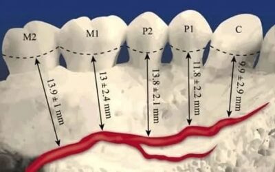 maxillary posterior teeth and the maxillary sinus or neurovascular bundle