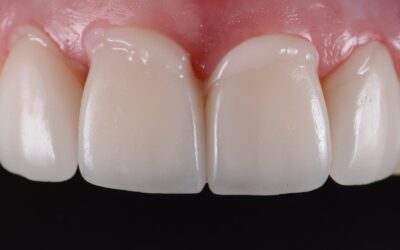 Advantages of Bonded Restorations in Dentistry