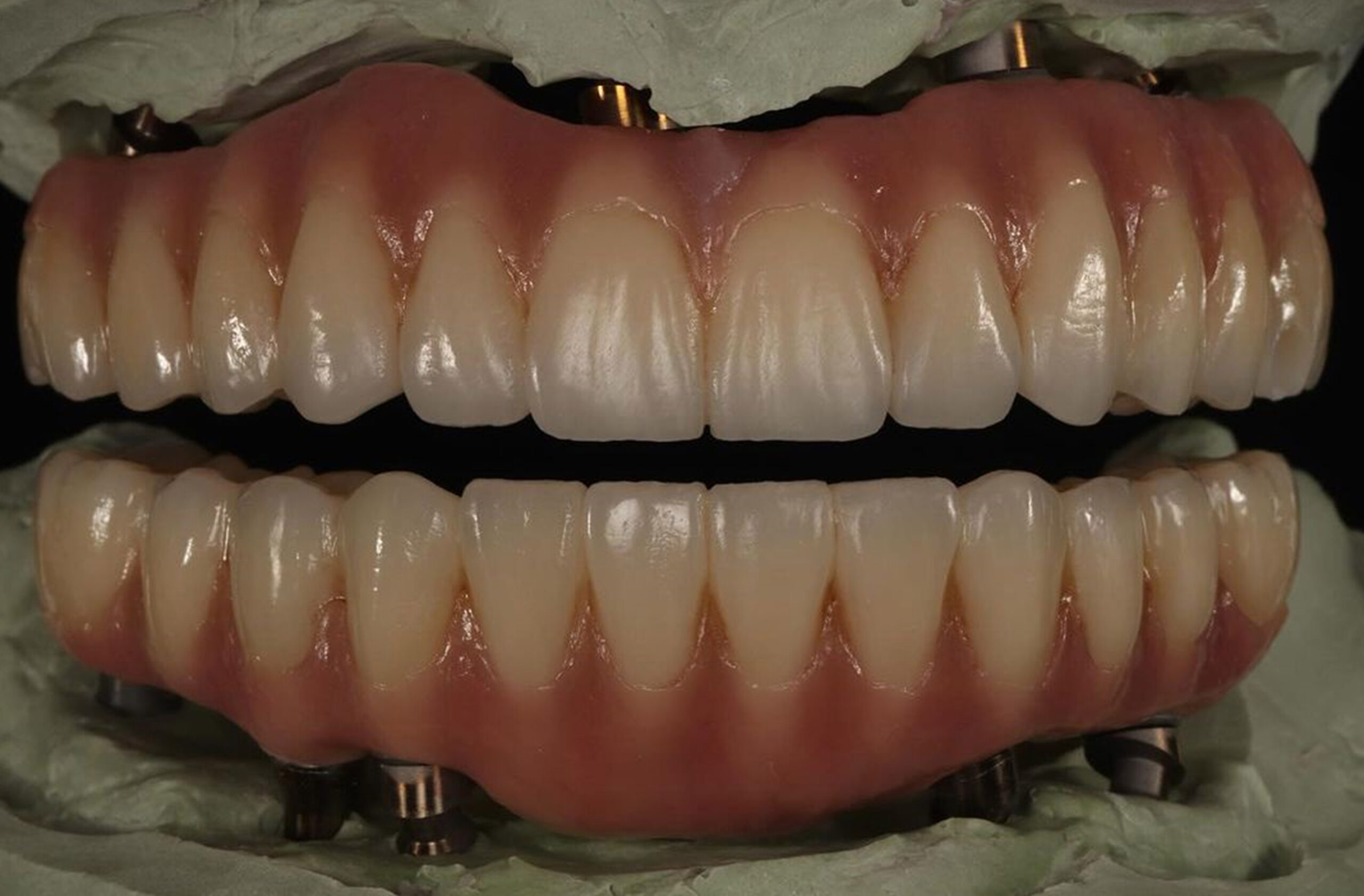 fast track implants course