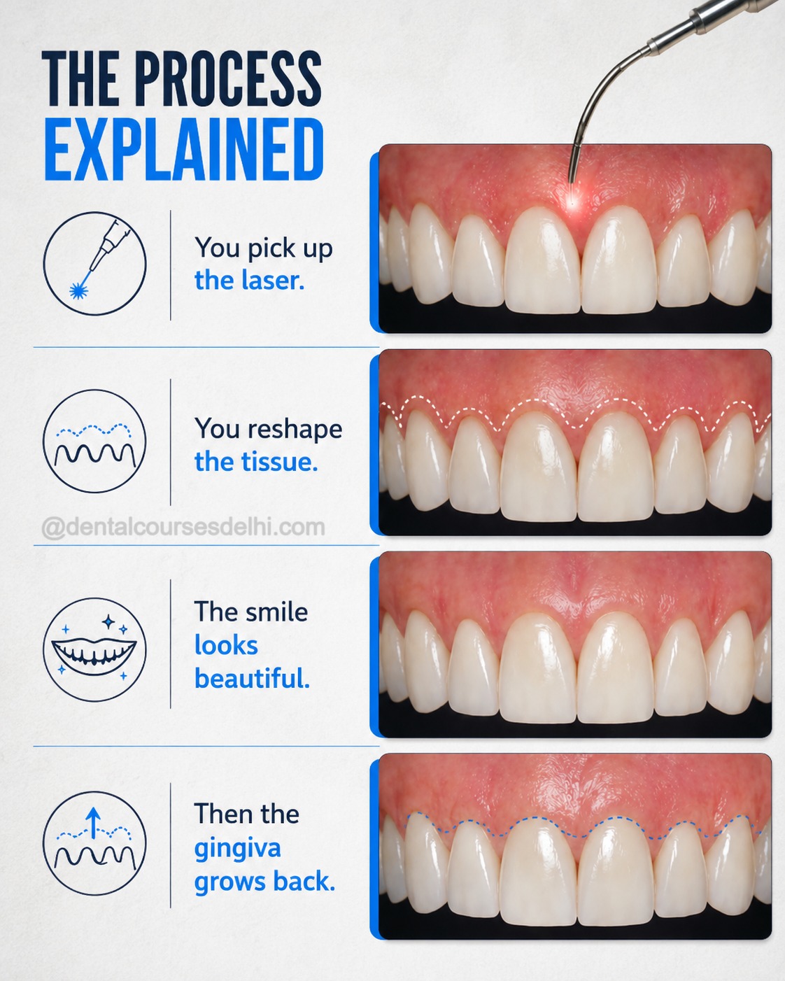 Why Some Gum Surgeries Relapse (And Others Last for Years) (1)