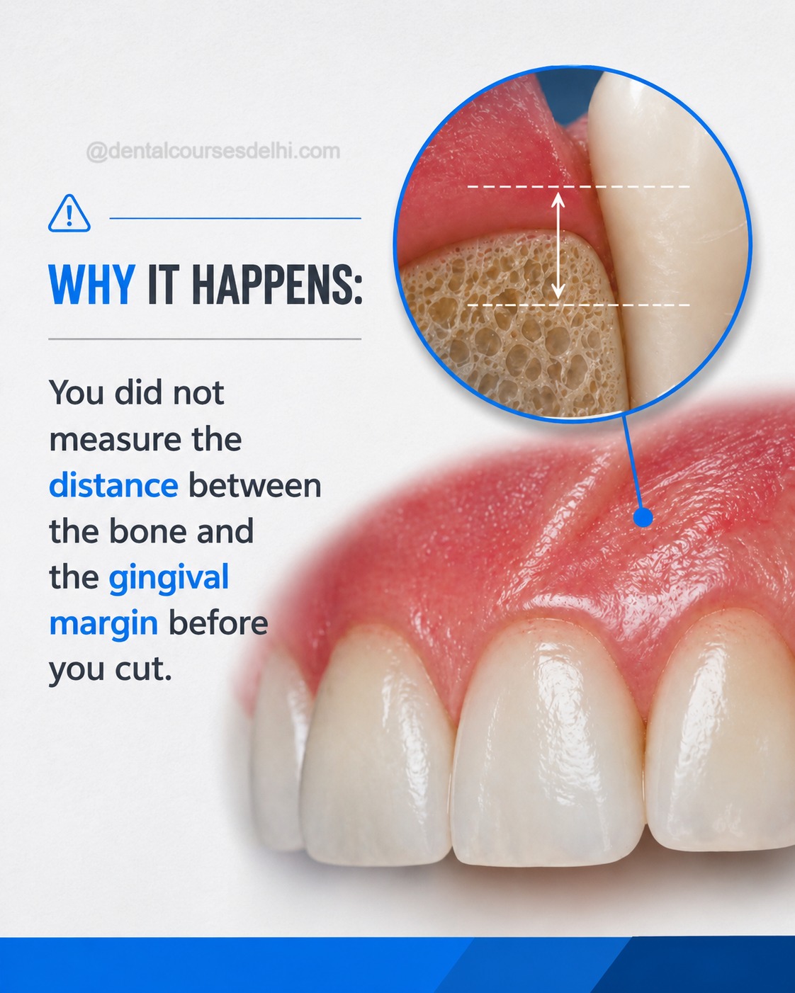 Why Some Gum Surgeries Relapse (And Others Last for Years) (7)